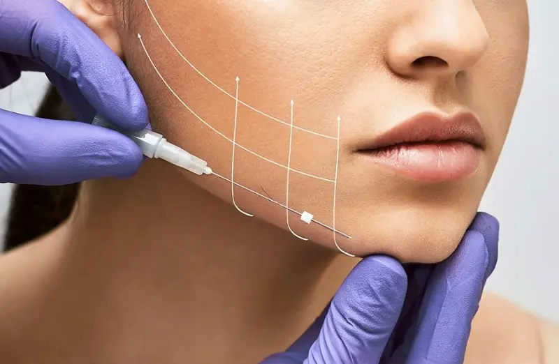 Căng chỉ collagen có thể gây ra tác dụng phụ nếu không được thực hiện đúng kỹ thuật