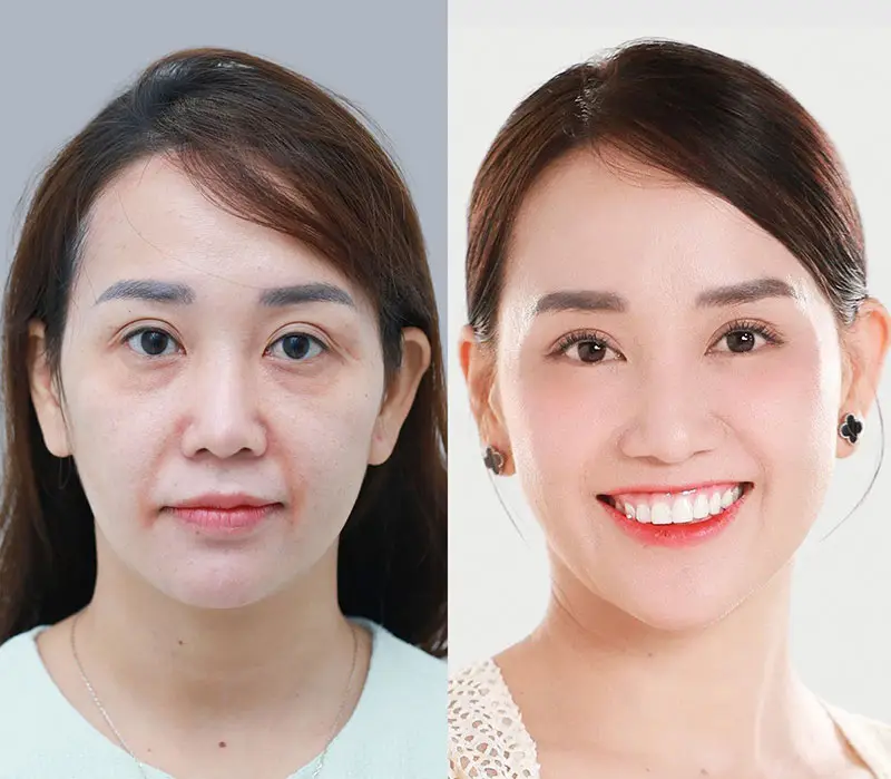 Căng chỉ collagen Kangnam mang lại hiệu quả trẻ hóa cao
