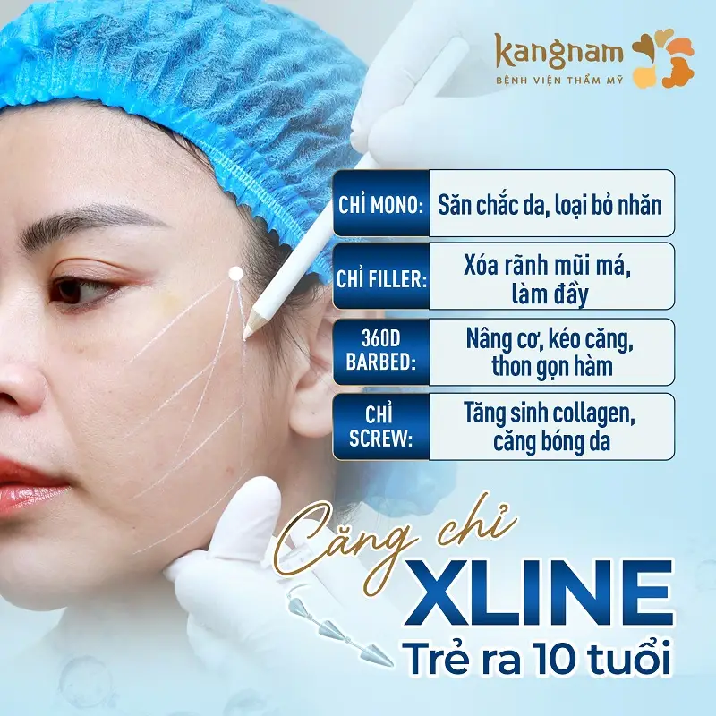 Ứng dụng căng chỉ Xline đến từ Thụy Sỹ, giúp loại bỏ nếp nhăn, vùng da chảy xệ