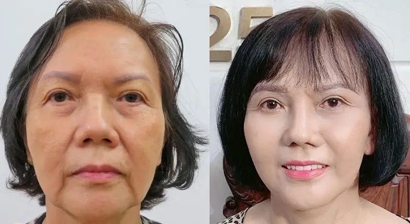 Sau khi da mặt hết sưng khách hàng sở hữu khuôn mặt tươi trẻ, căng bóng