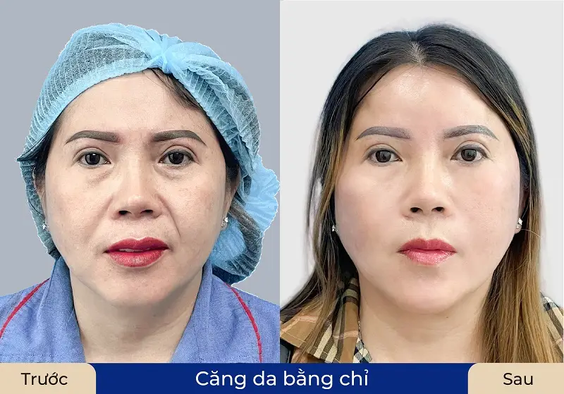 Thực hiện chăm sóc đúng cách giúp khách hàng nhanh chóng hết sưng, khuôn mặt đẹp tự nhiên