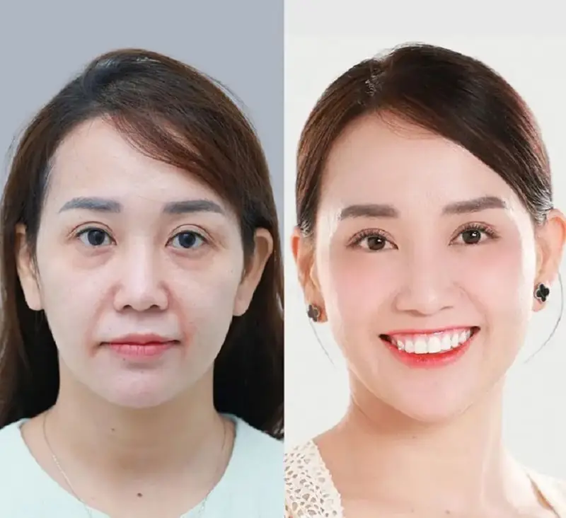 Căng chỉ giúp khắc phục tình trạng da nhăn nheo, chảy xệ