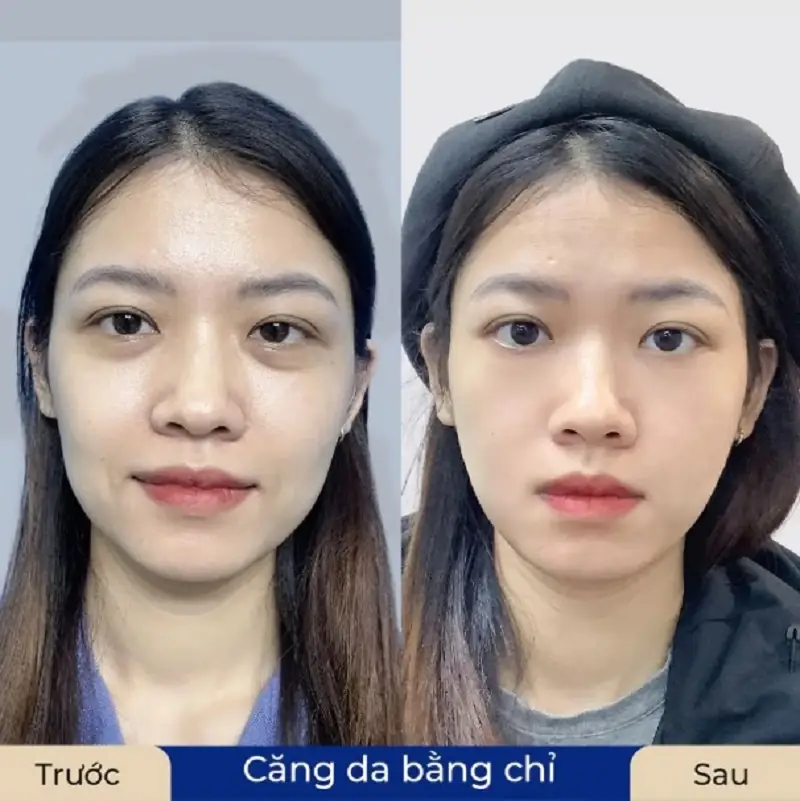 Kangnam ứng dụng căng chỉ chất lượng cao, duy trì độ bền lâu dài