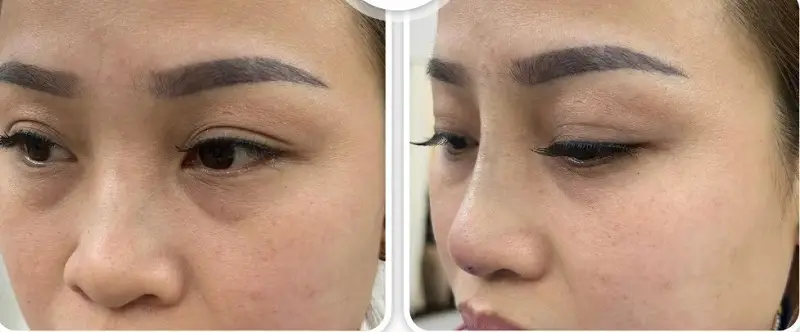 Sau 1 tháng nâng mũi bằng chỉ mũi sẽ ổn định vào form đẹp như ý