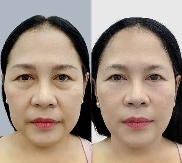 Căng chỉ rãnh cười sẽ đẹp sau 1 tuần