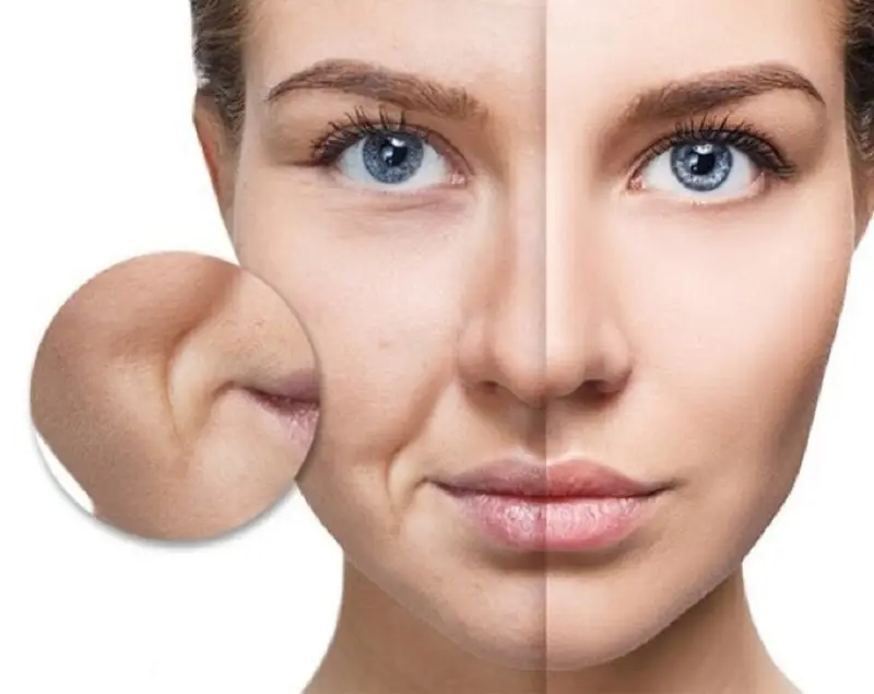 Căng chỉ rãnh cười duy trì hiệu quả từ 3 - 5 năm