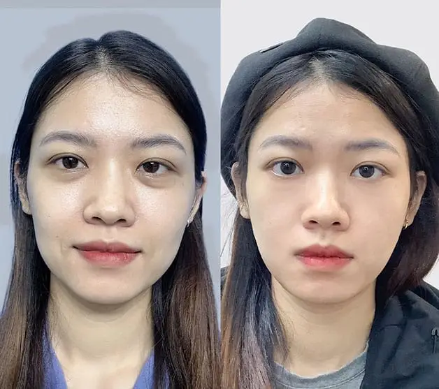 Căng chỉ Xline tại Kangnam có chi phí phù hợp