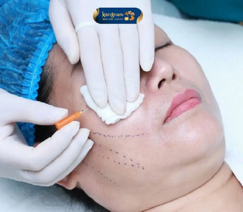 Sợi chỉ giúp kích thích sản sinh collagen