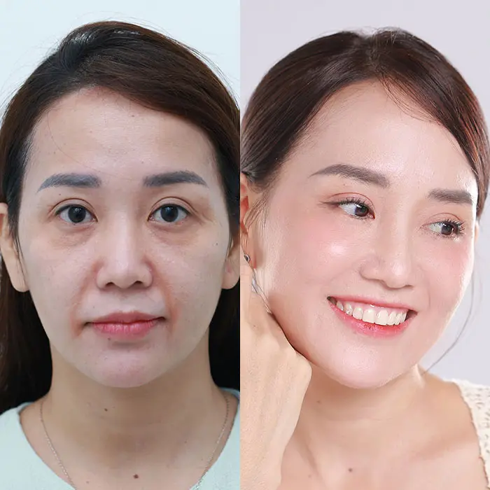 Căng chỉ Xline Bio Young - Giải pháp trẻ hóa toàn diện