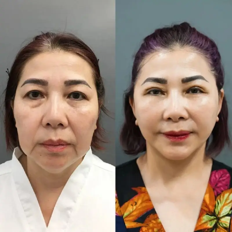 Căng da mặt bằng chỉ sẽ không cần phải cắt chỉ