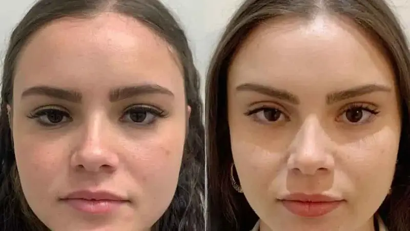 Những trường hợp phẫu thuật căng da mặt sẽ cắt chỉ khi vết thương lành