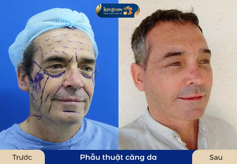 Sau khi da mặt hết sưng gương mặt sẽ tươi trẻ, căng bóng hơn
