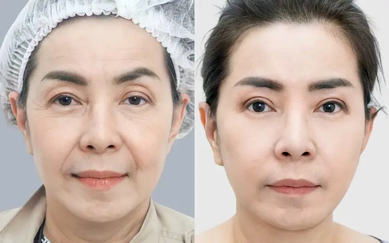 Kiêng ăn hải sản theo thời gian hướng dẫn của bác sĩ giúp khách hàng nhanh chóng phục hồi sau căng da mặt