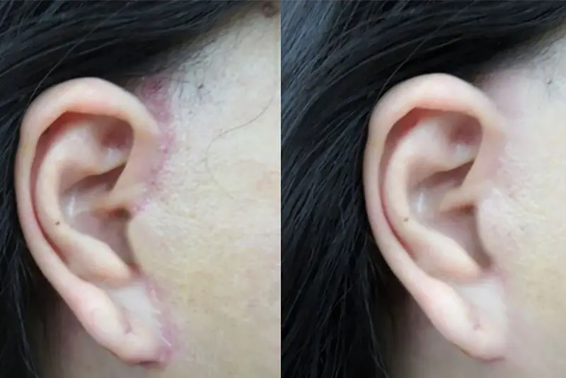 Sẹo sau phẫu thuật căng da mặt sẽ mờ dần