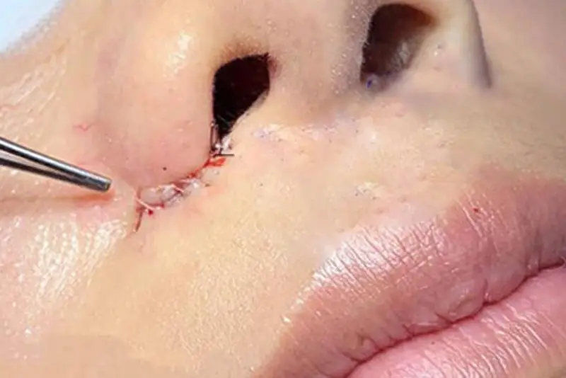 Không nên cắt chỉ quá sớm