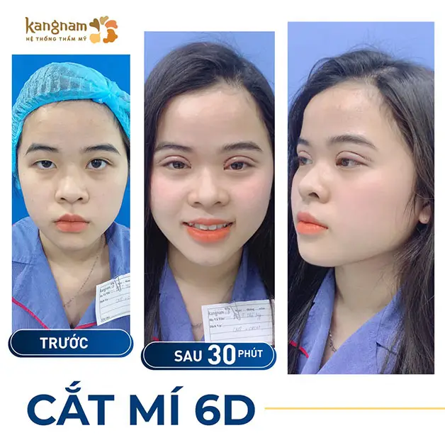 Nếp mí đẹp tự nhiên sau khi cắt mí 6D