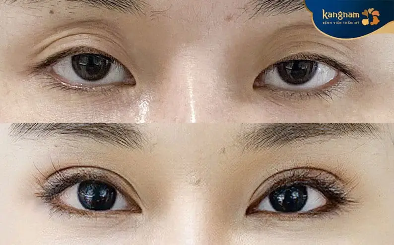 Cấy mỡ hốc mắt sâu duy trì hiệu quả 