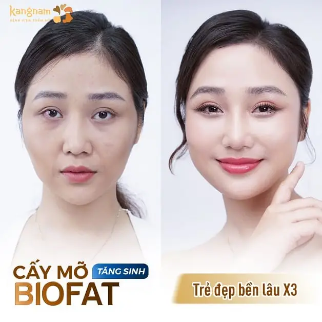 Cải thiện vóc dáng tự nhiên với mỡ tự thân Biofat