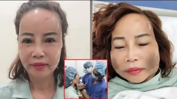 Cấy mỡ tự thân thì bao lâu là hết sưng