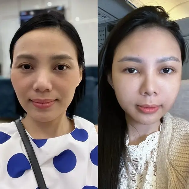 Cấy mỡ mặt có tỷ lệ sống dao động từ 30 - 40%