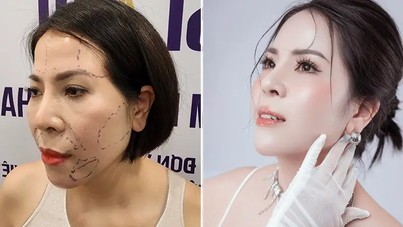 Khách hàng nên tuân thủ theo hướng dẫn chăm sóc của bác sĩ