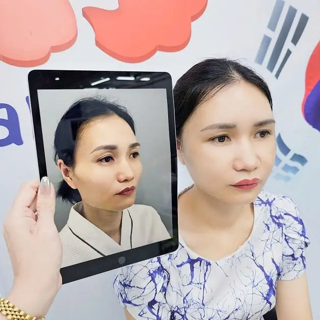 Cấy mỡ tự thân có xảy ra tình trạng ngót hoặc tiêu mỡ