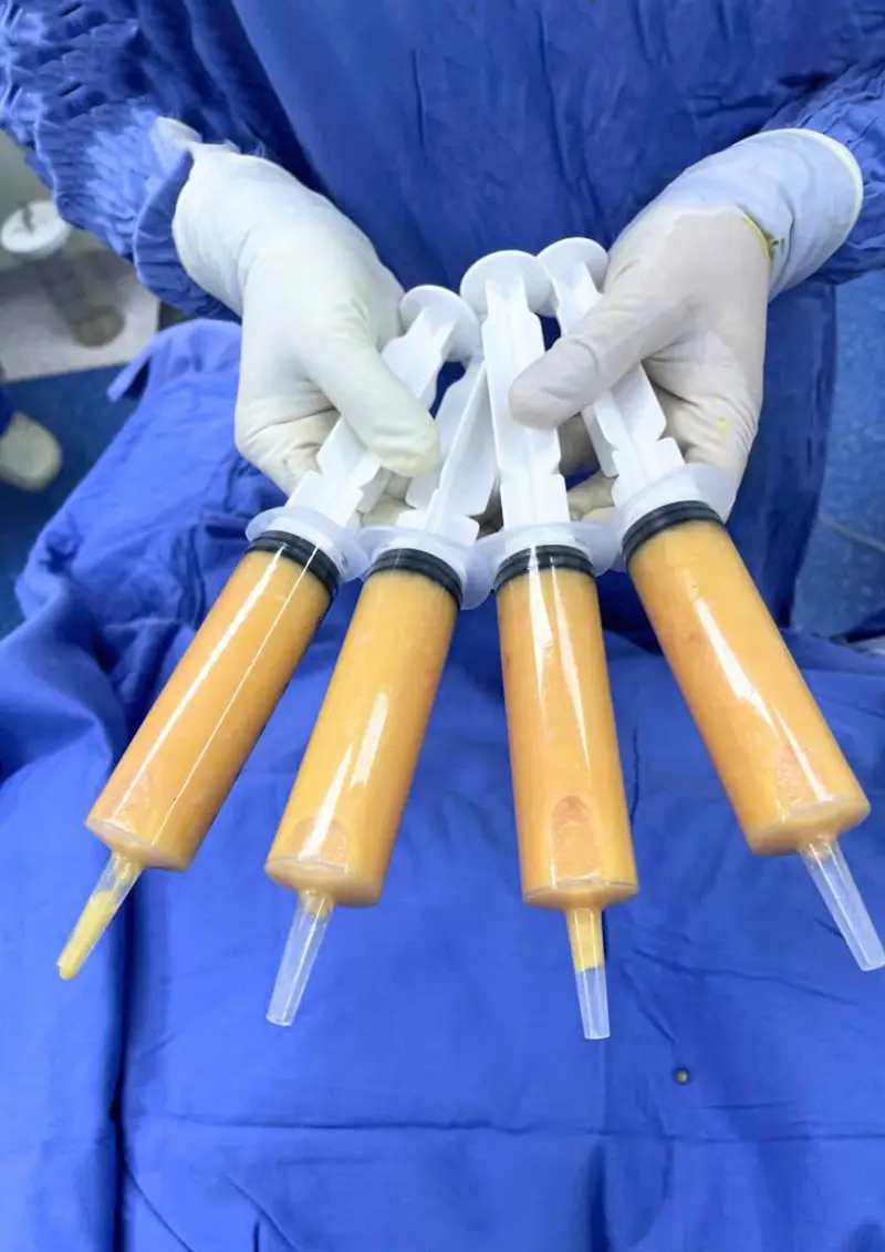 Địa chỉ thẩm mỹ thực hiện cũng ảnh hưởng đến thời gian duy trì sau cấy mỡ