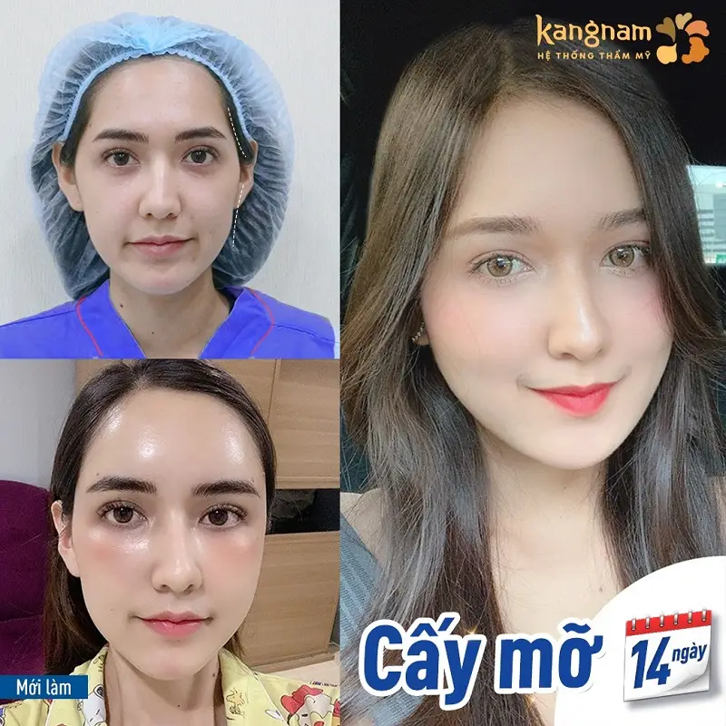 Khách hàng sở hữu khuôn mặt đầy đặn, cân đối sau khi cấy mỡ