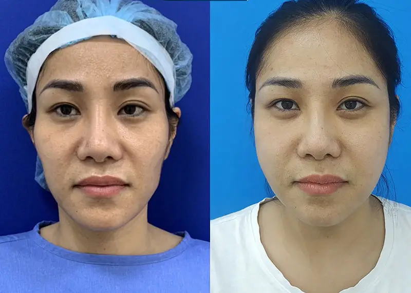 Cấy mỡ tự thân giữ được từ 1 - 2 năm với vùng mặt, 5 - 10 năm với ngực và mông