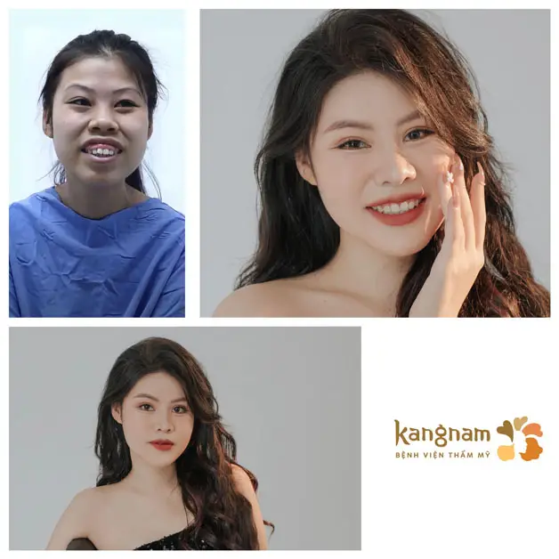 Khách hàng thăng hạng nhan sắc sau khi điều chỉnh hàm hô chữa cười hở lợi tại Kangnam