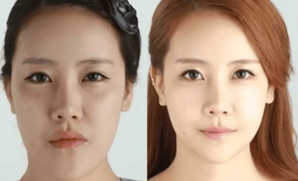 Tình trạng lệch hàm khắc phục hoàn toàn mặt lệch