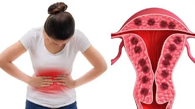 Nếu chị em đến kỳ kinh nguyệt thì không nên đi cắt mí