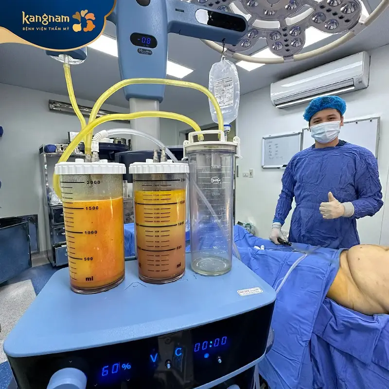 Giảm mỡ Lipo 360 loại bỏ mỡ thừa chính xác, nhanh chóng