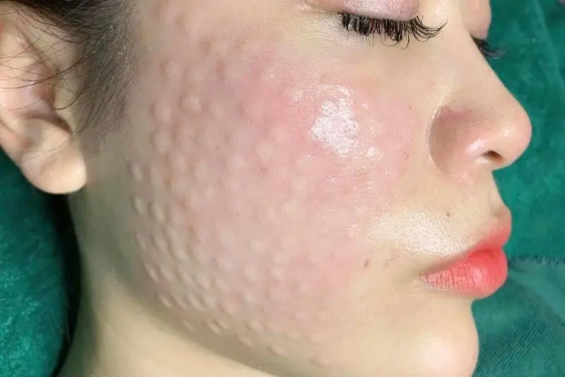 Đỏ nhẹ sau tiêm meso thường biến mất sau khoảng vài giờ đến vài ngày