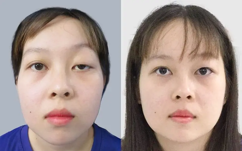 Cắt mí khắc phục được tình trạng mí sụp, mí lót, mí ẩn