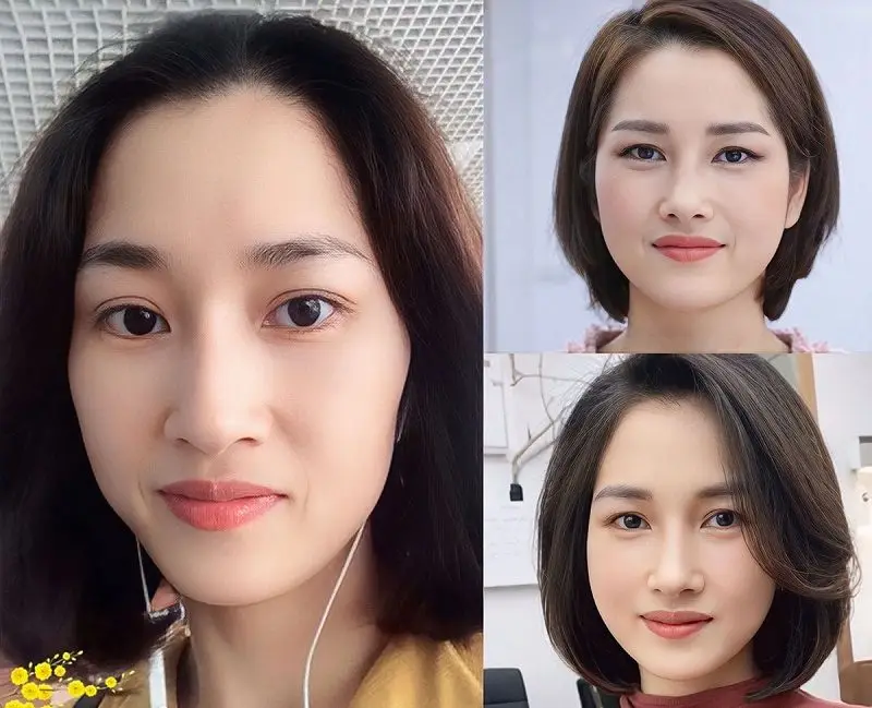 Với những người có khuôn mặt hóp nhiều sẽ cần nhiều mỡ để cấy hơn