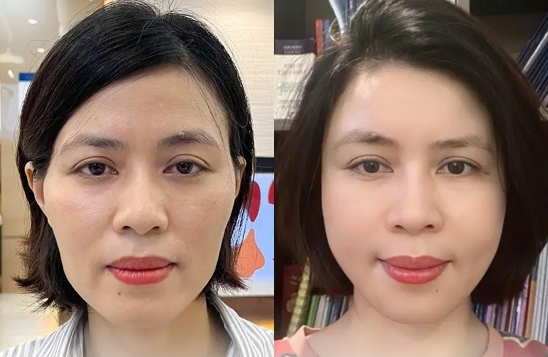 Cấy mỡ công nghệ cao giúp duy trì độ bền lâu dài