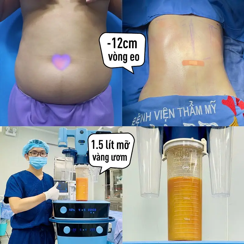 Giảm mỡ Lipo 360 đào thải mỡ thừa ra ngoài an toàn