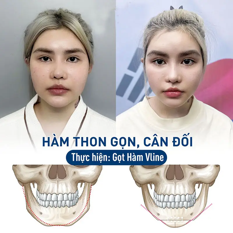Gọt hàm Vline can thiệp vào xương hàm dưới, giúp tạo hình cằm thon gọn