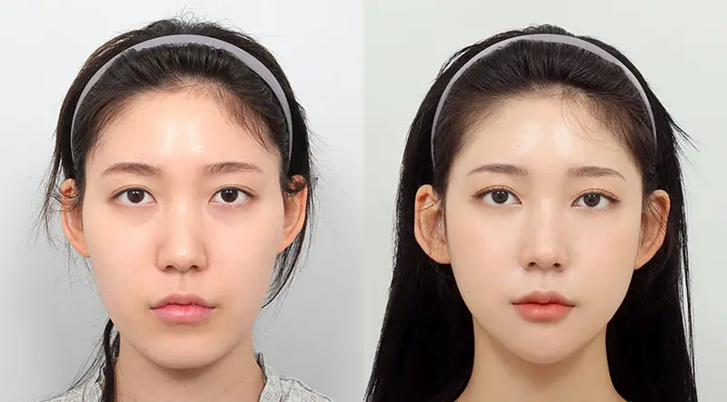 Hạ gò má lành vết thương sau khoảng 10-14 ngày
