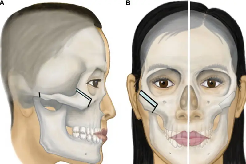 Nẹp vít có thể tháo sau 1 năm phẫu thuật