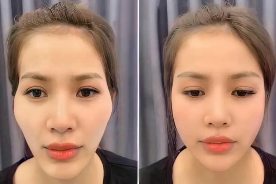 Filler rãnh cười giúp khuôn mặt baby hơn 