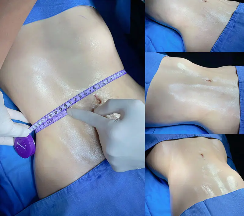 Hút mỡ bụng giúp vùng eo săn chắc thon gọn