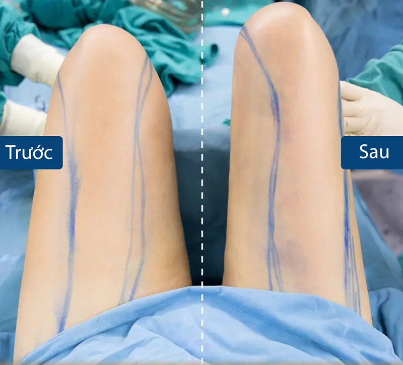 Hút mỡ đùi là phương pháp giúp loại bỏ mỡ thừa nhanh chóng