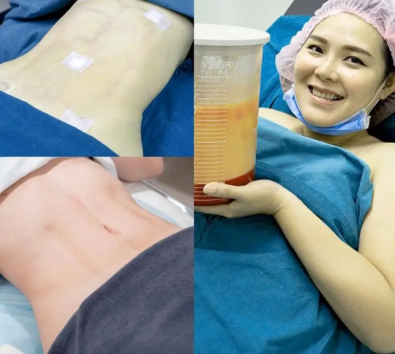 Lượng mỡ hút ra sẽ được bác sĩ tính toán phù hợp