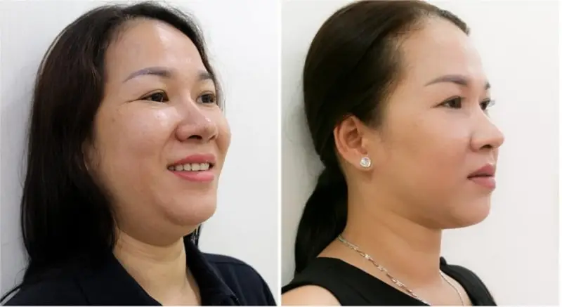 Với một số địa chỉ nếu loại bỏ nhiều mỡ thừa ở nọng cằm sẽ có giá cao hơn