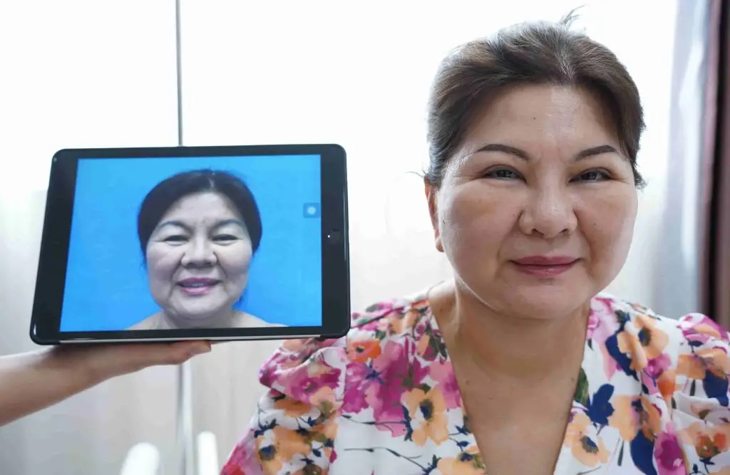 Căng da mặt bằng chỉ và phẫu thuật căng da mặt 3D là phương pháp phổ biến