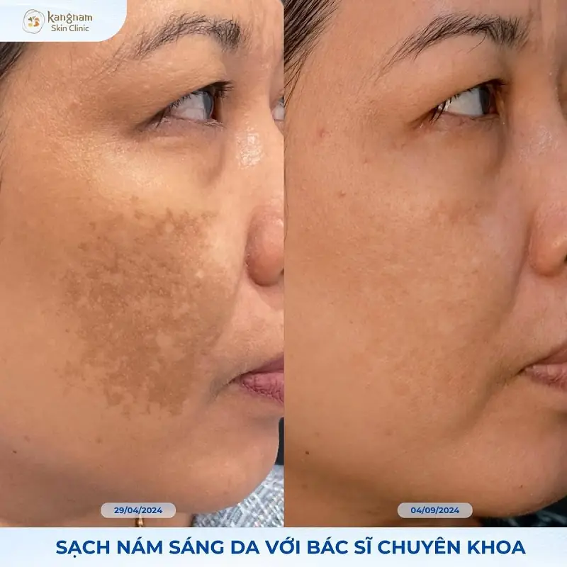 Kangnam Biozen điều trị tình trạng nám, tàn nhang, sắc tố da