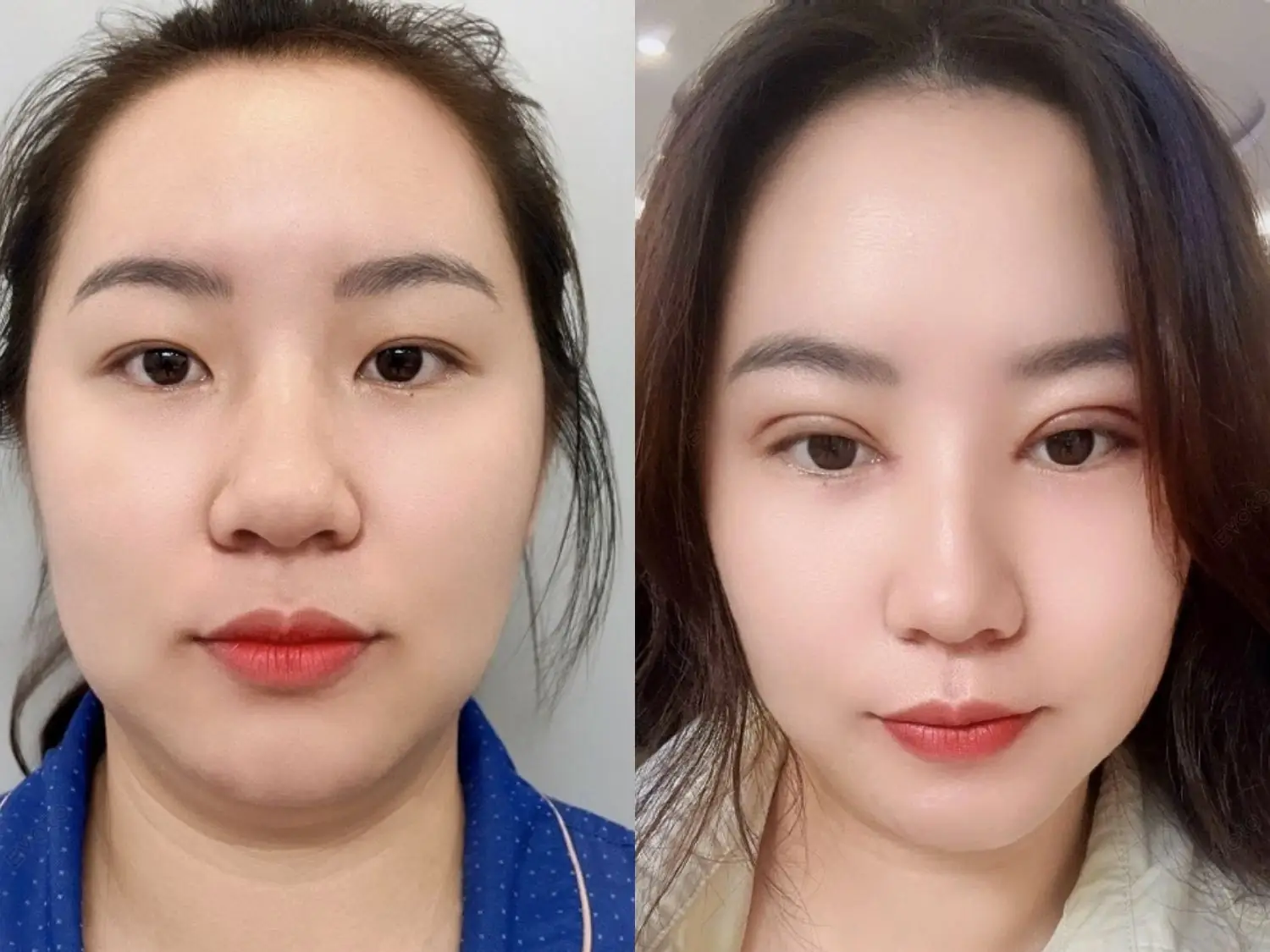Hình ảnh thực tế cho thấy nếp mí của Thanh Hiền đã ổn định, rõ nét và to tròn hơn chỉ sau 1 tuần.
