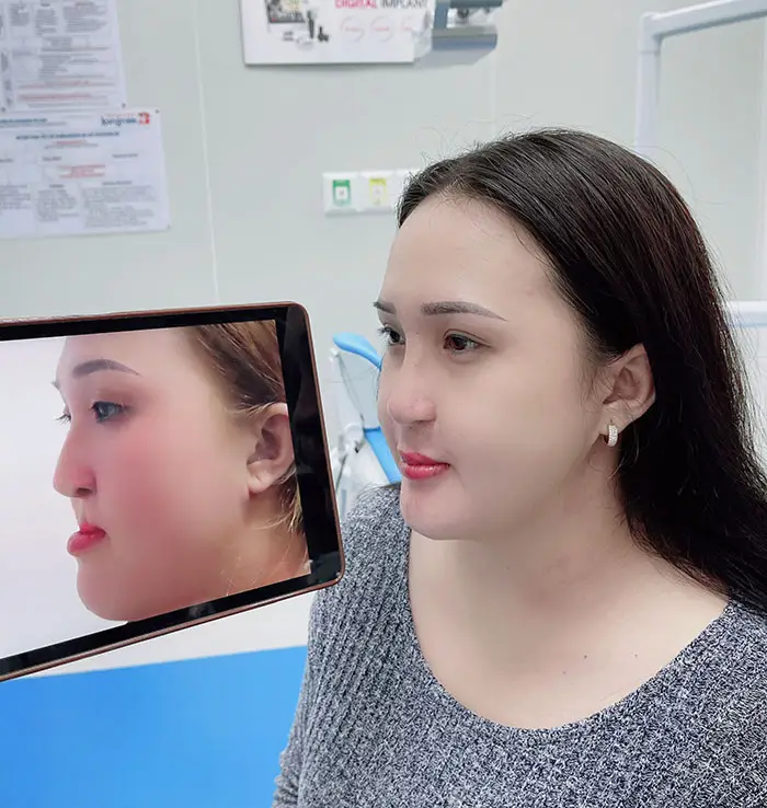 Sau 3-4 tuần phẫu thuật hàm móm, các chức năng cơ bản